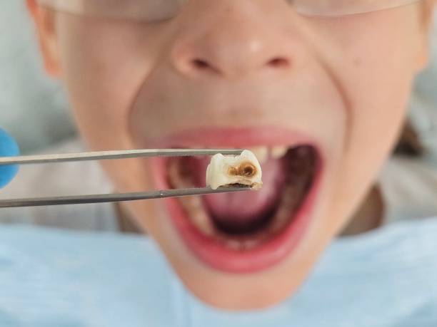 Best Emergency Treatment for Toothache in Salineville, OH